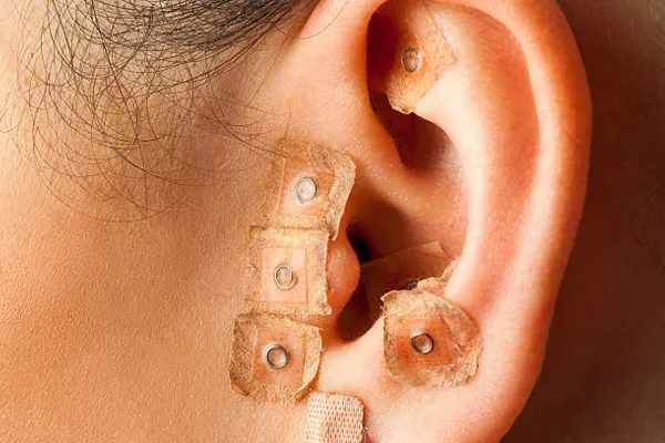 auriculoterapia